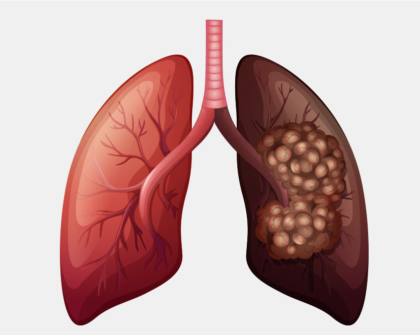 Ung thư phổi di căn có thể gây khàn tiếng